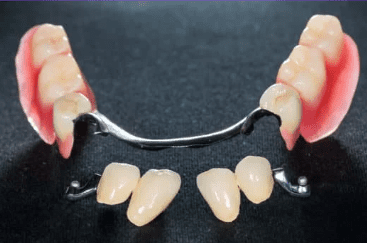 fixed vs removable dentures