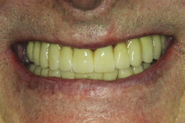 Réhabilitation complète - Parodontite, extraction des dents, pose des  implants, pose des prothèse sur barre de rétention (Présentation de cas)  (55)