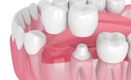 dental-bridge-cantilever