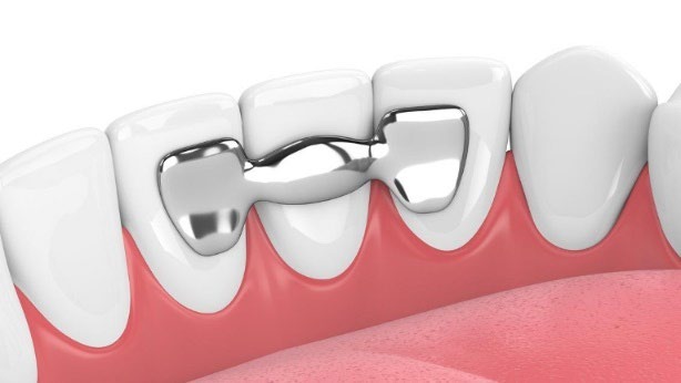 dental-bridges-maryland