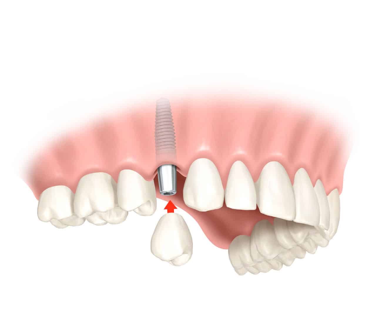 crown on implant