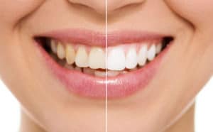 blanchiment dentaire