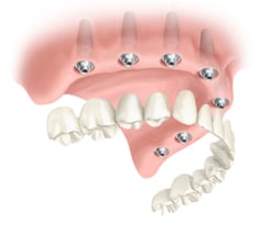 fixed vs removable dentures