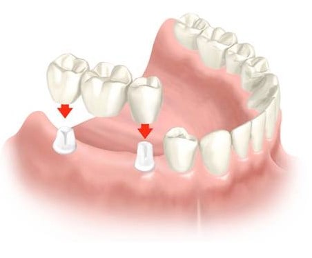 Dental bridge spain