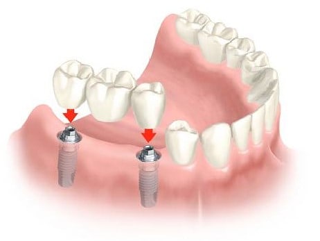 Dental bridge on implants