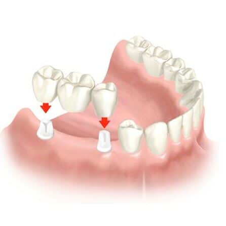 dental bridge