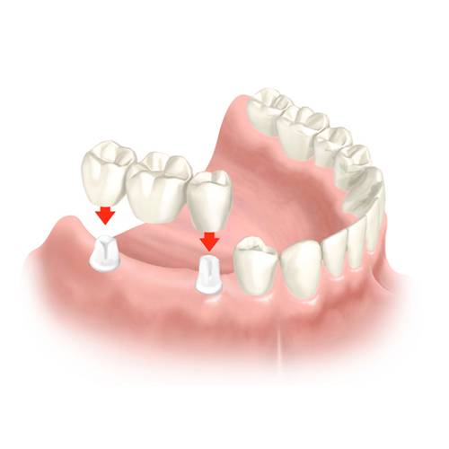 dental bridge