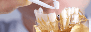 dental implant