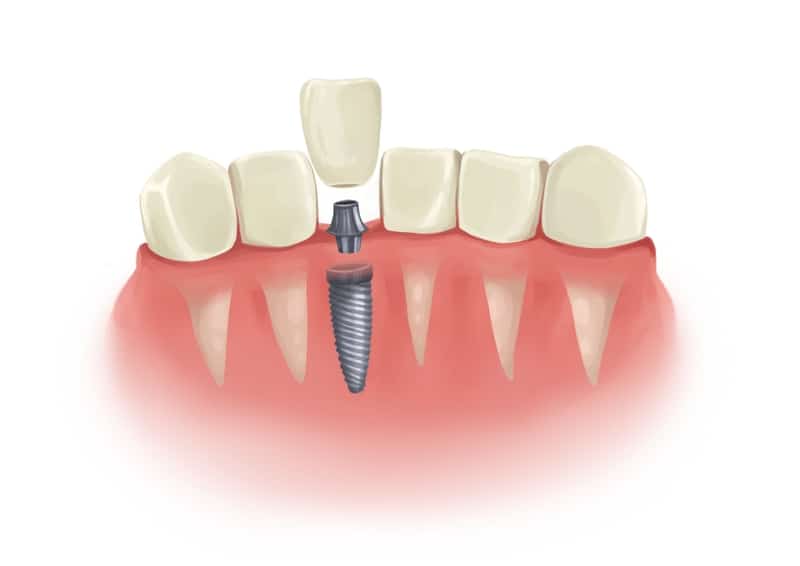 dental implant