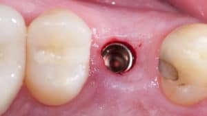 flapless implant dentaire