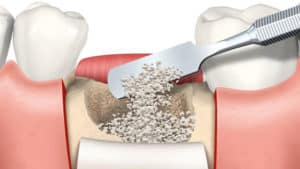greffe osseuse implant dentaire