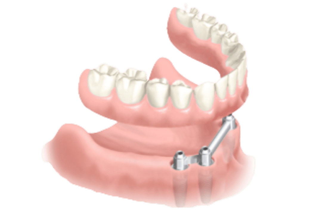 stabilised prothesis